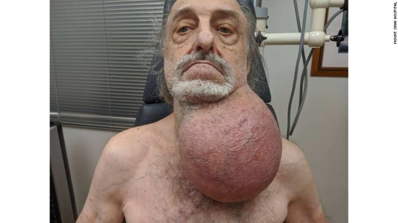 Nádor veľkosti futbalovej lopty mu výrazne ohrozoval život, lekári mu nevedeli pomôcť. Po 7 hodinovej operácii je konečne preč