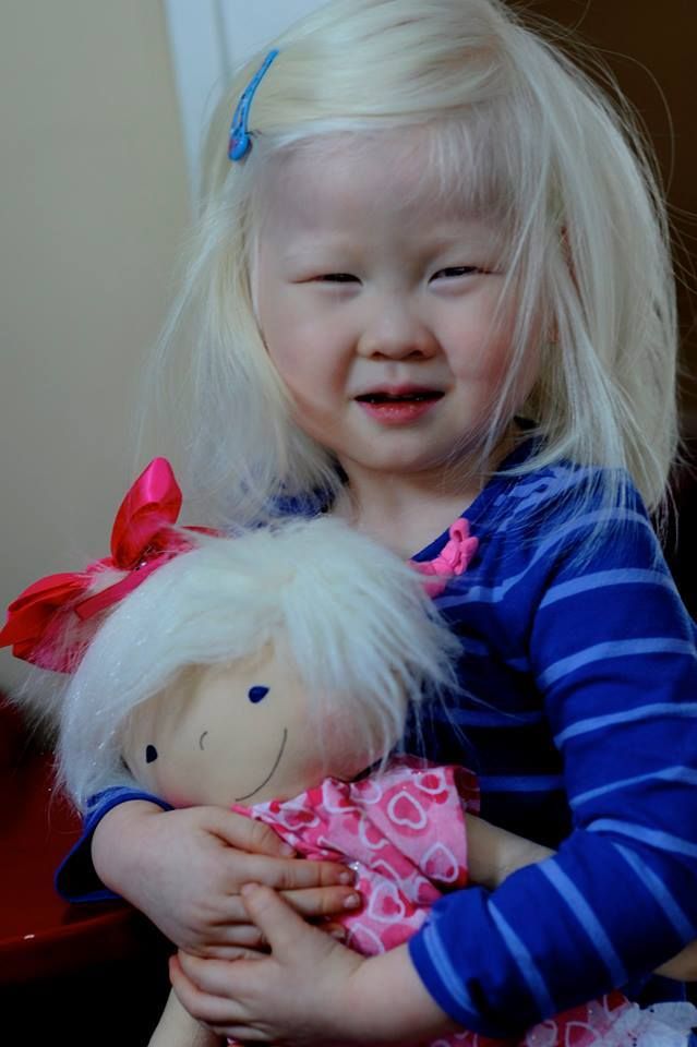 Žena vyrába pre postihnuté deti nedokonalé bábiky s rovnakým hendikepom. Vďaka nim si nepripadajú odlišne