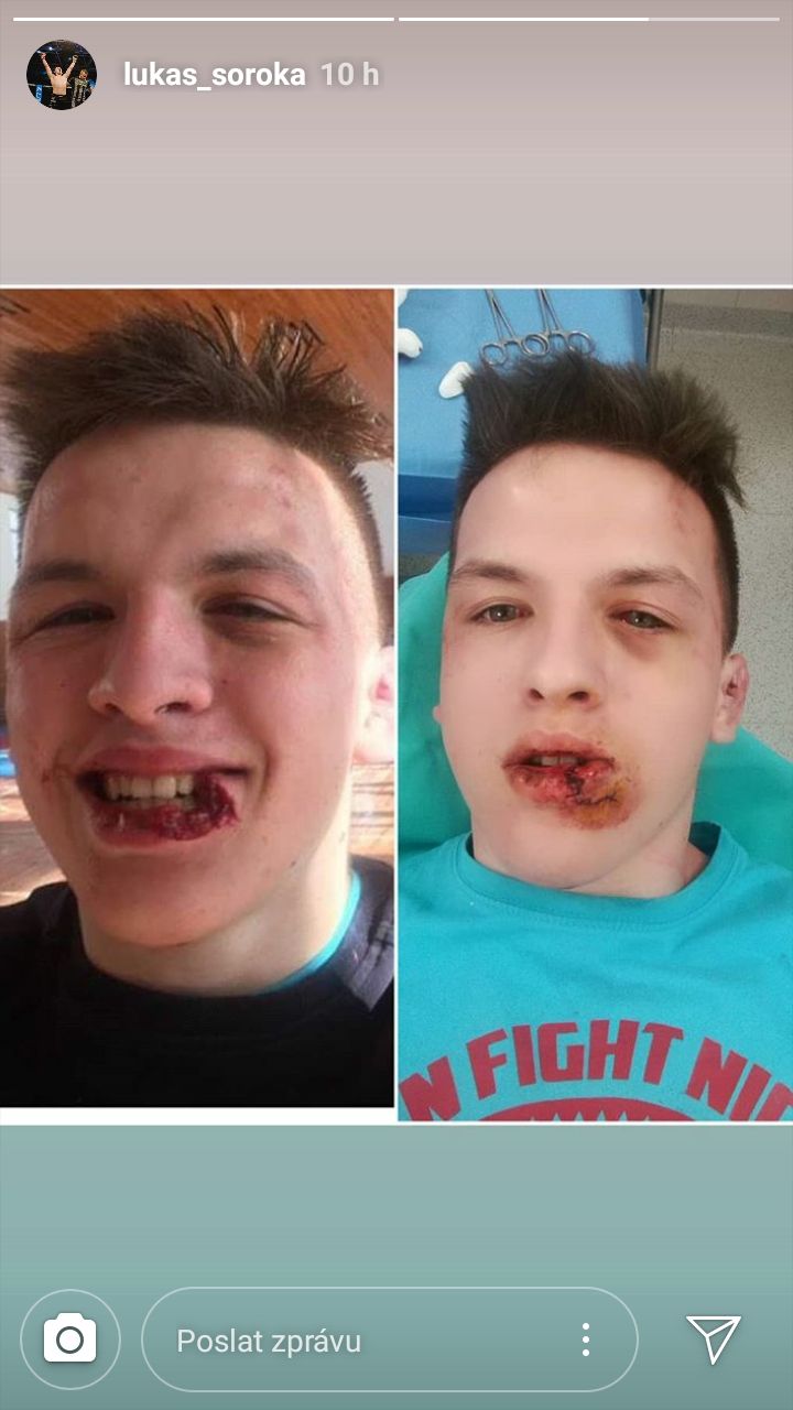 16letý slovenský MMA bojovník utrpěl hrozivé zranění během přípravy v Tatrách