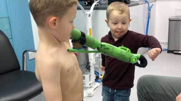 5-ročný chlapec dostal protézu inšpirovanú Hulkom, aby mohol objať svojho mladšieho brata